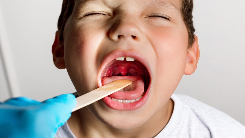 Tonsillitis In Children