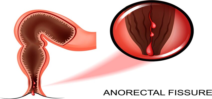 What is anal fissure