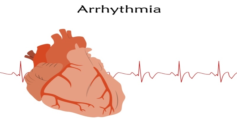 What is Arrhythmia in Children?