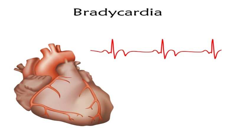 What is Bradycardia in Children?