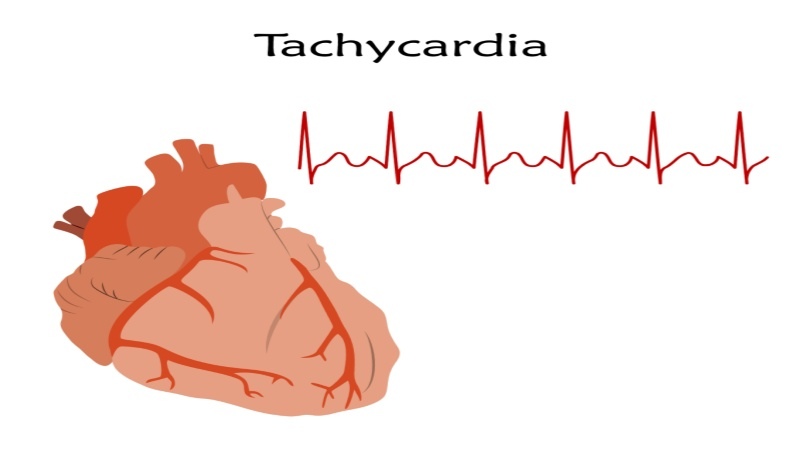 What is Tachycardia in Children?