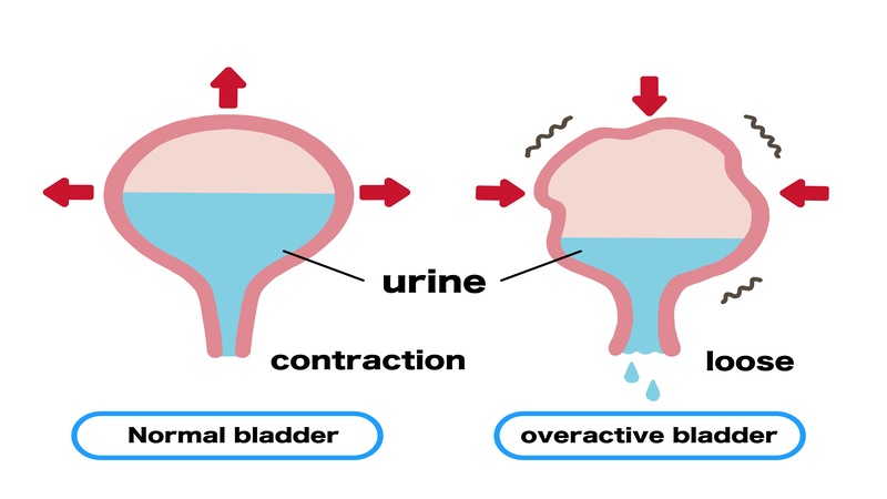 What is an Overactive Bladder (OAB)?