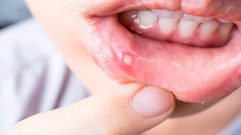 Canker sores in toddlers