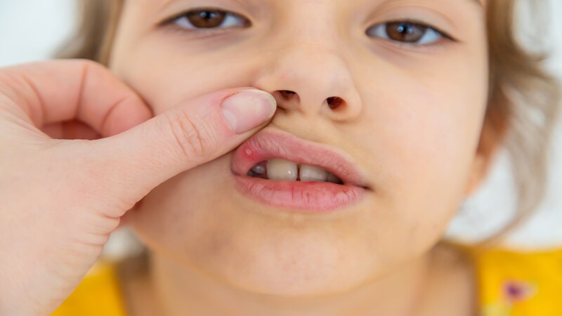 What Are Canker Sores?