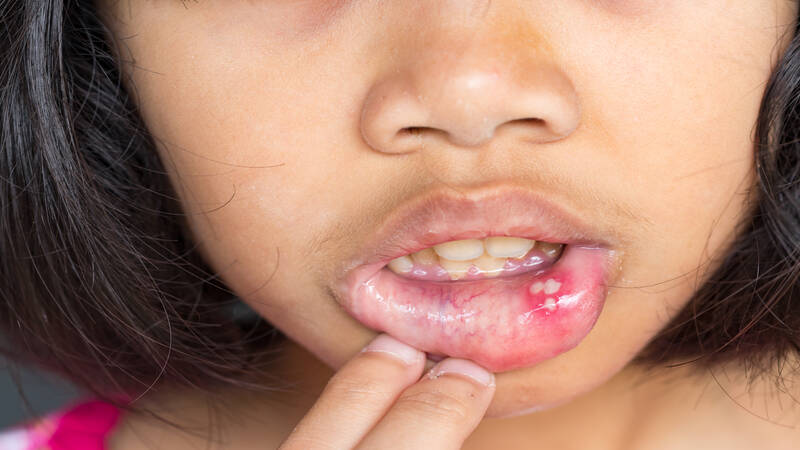 What Are The Symptoms of Canker Sores in Toddlers?