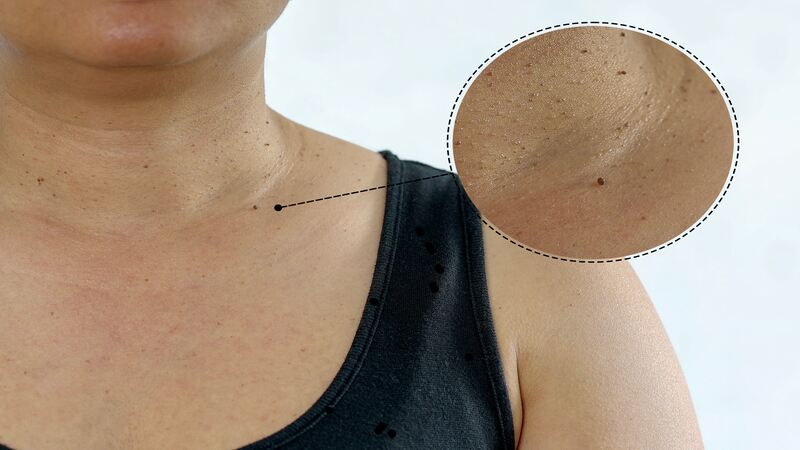 Skin tags