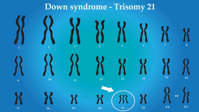 What Causes Down Syndrome?