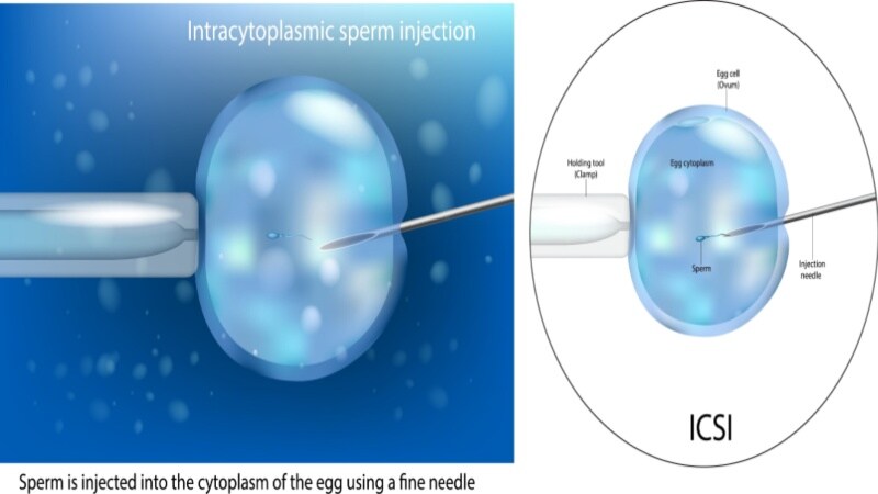 ICSI for infertility 