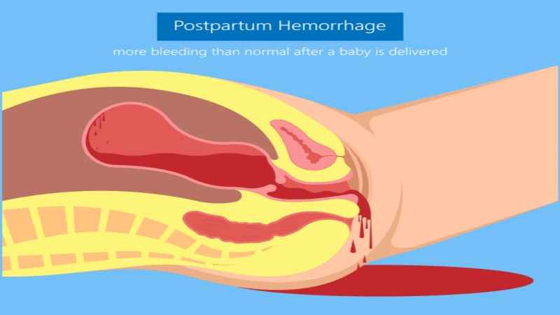 Postpartum hemorrhage inforgraphics