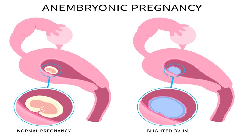 What Is A Blighted Ovum_