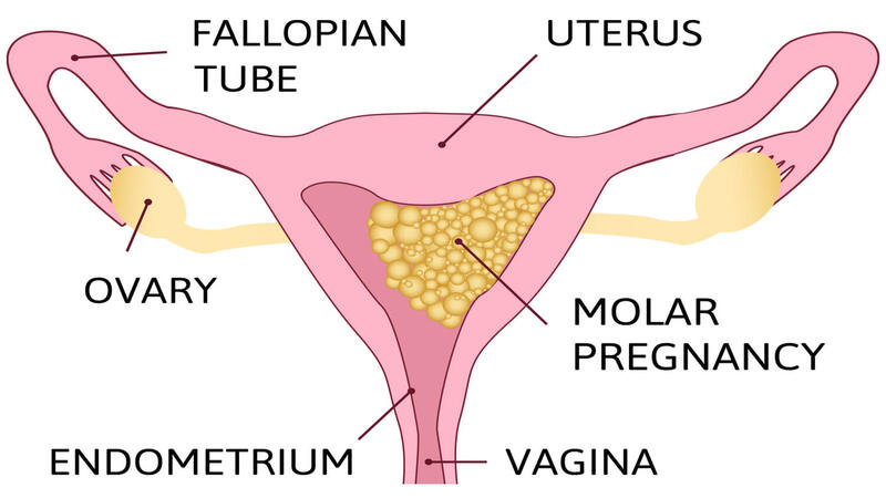 molar-pregnancy