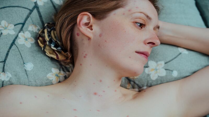 Chickenpox In Pregnancy