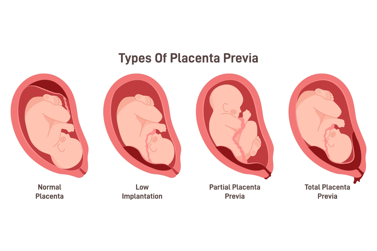 Types of Placenta Previa