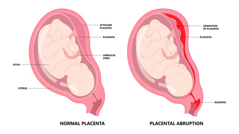 What is Placental Abruption _