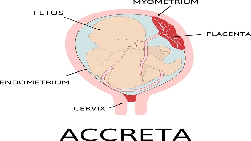 placenta-accreta