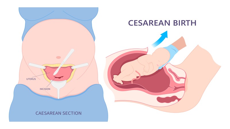 Challenges Associated With a Cesarean Delivery