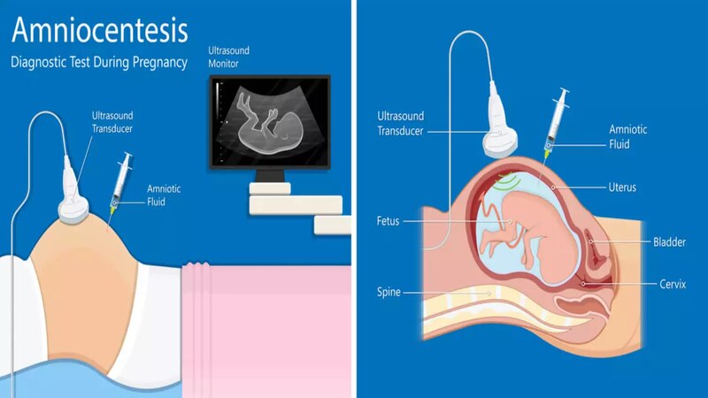 Amniocentesis-test