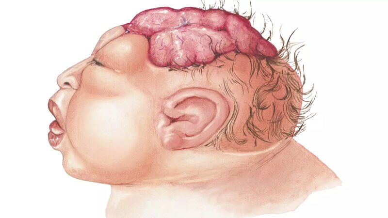 anencephalic-baby