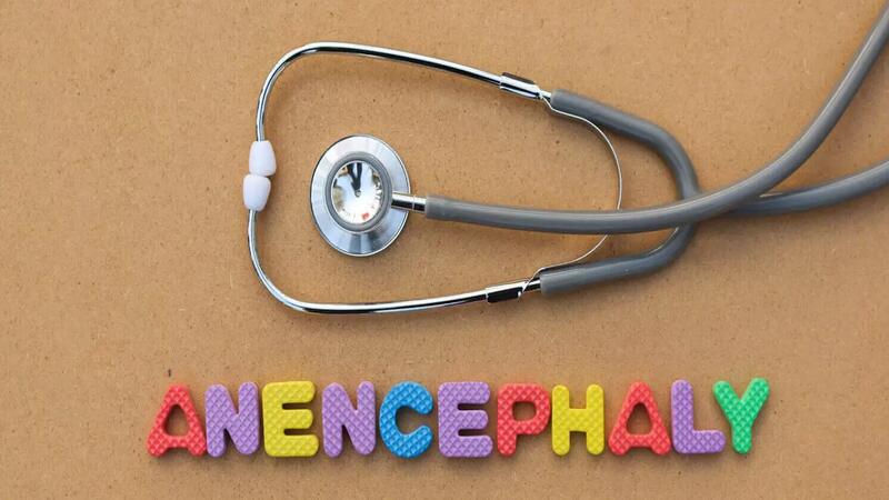 anencephaly